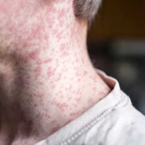Measles viral on a man's neck