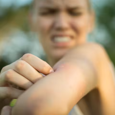 A woman scratching her itchy mosquito bite.