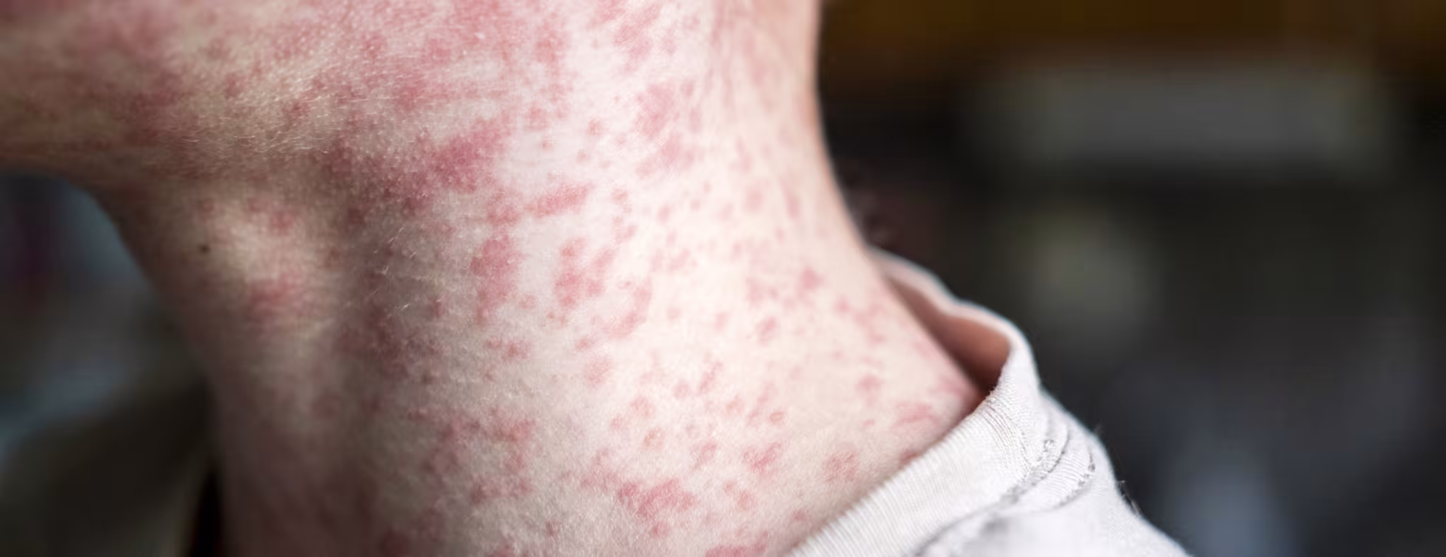 Measles viral on a man's neck