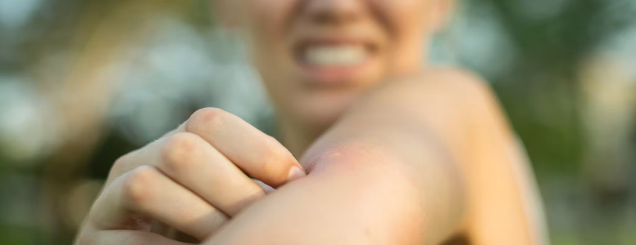 A woman scratching her itchy mosquito bite.